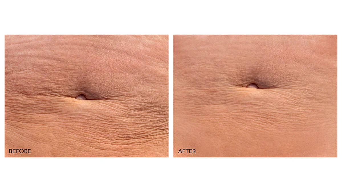 Microcurrent body sculpting before and after on the belly, closeup